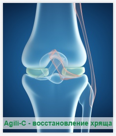 Восстановление хряща коленного сустава народными средствами. Артроз коленного сустава - статьи от компании Еламед Лечение Коленного Сустава Народными Средствами Russianhunt Магазин. ✅ Бурсит коленного сустава | Тейпирование колена | Бурсит лечение