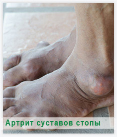 Артрит стопы: симптомы и лечение - статьи от компании Еламед