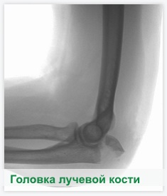 Головка лучевой кости локтевого сустава. Локтевой сустав — Медицинская энциклопедия Подробно расскажем о Чем образован локтевой сустав Повреждения в области локтевого сустава - Медицина - Загальна медична.