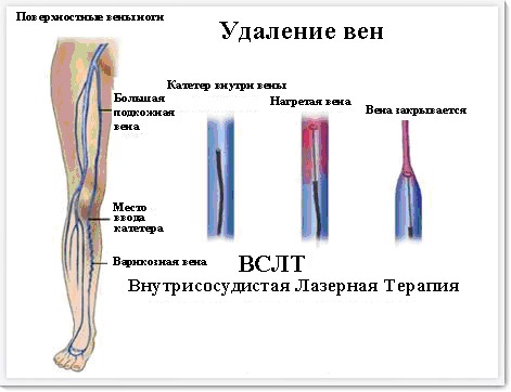 endovascular-laser-therapy2.jpg